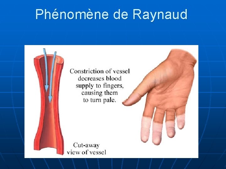 Phénomène de Raynaud 