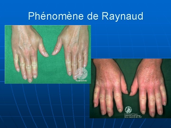 Phénomène de Raynaud 