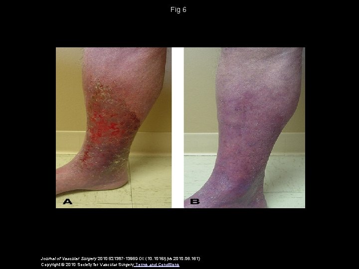 Fig 6 Journal of Vascular Surgery 2010 521387 -1396 DOI: (10. 1016/j. jvs. 2010.