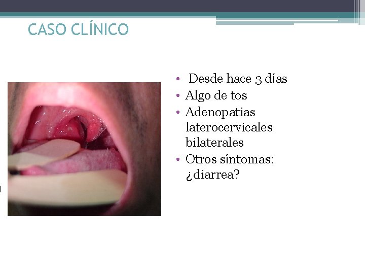 CASO CLÍNICO • Desde hace 3 días • Algo de tos • Adenopatias laterocervicales