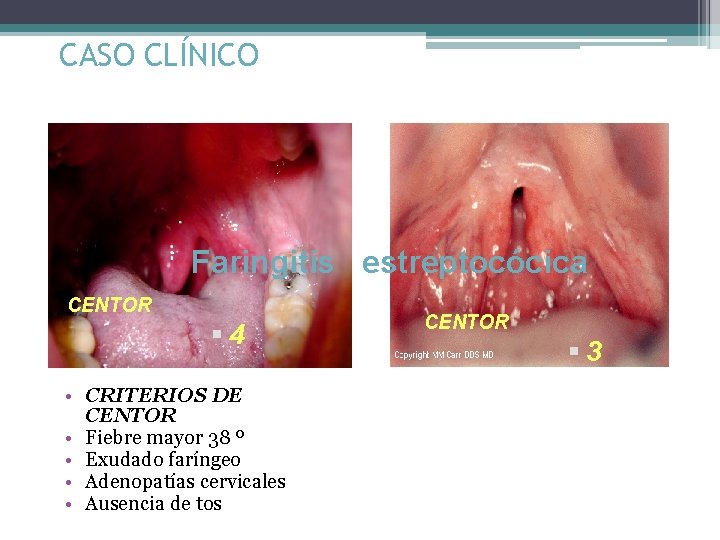 CASO CLÍNICO Faringitis estreptocócica CENTOR § 4 • CRITERIOS DE CENTOR • Fiebre mayor