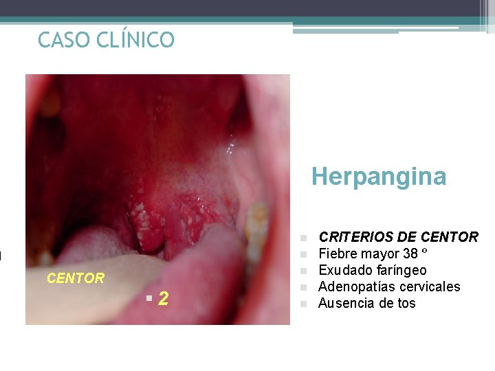 CASO CLÍNICO Herpangina n n n CENTOR § 2 n n CRITERIOS DE CENTOR