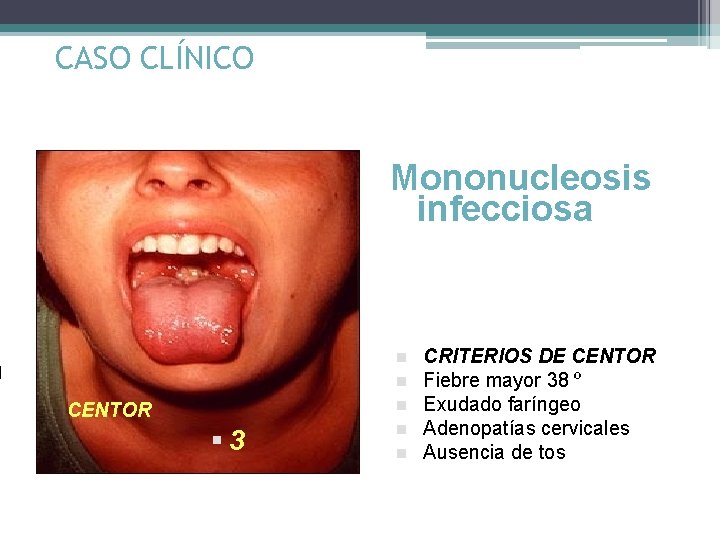CASO CLÍNICO Mononucleosis infecciosa n n n CENTOR § 3 n n CRITERIOS DE