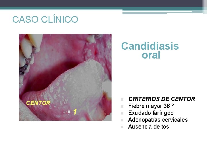 CASO CLÍNICO Candidiasis oral n CENTOR § 1 n n CRITERIOS DE CENTOR Fiebre