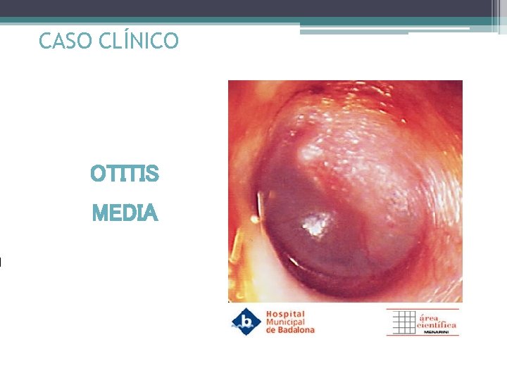 CASO CLÍNICO OTITIS MEDIA 