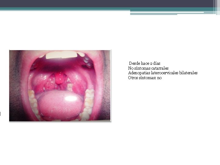  Desde hace 2 días No síntomas catarrales Adenopatias laterocervicales bilaterales Otros síntomas: no