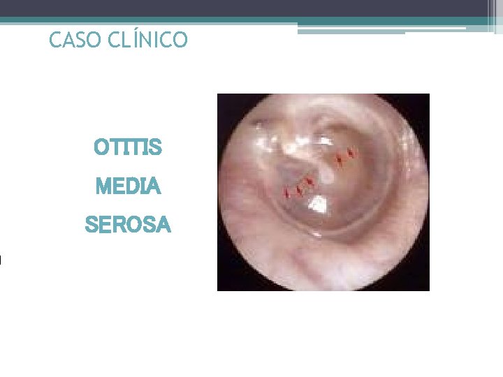 CASO CLÍNICO OTITIS MEDIA SEROSA 