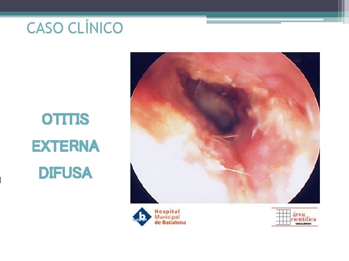 CASO CLÍNICO OTITIS EXTERNA DIFUSA 