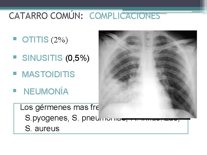 CATARRO COMÚN: COMPLICACIONES § OTITIS (2%) § SINUSITIS (0, 5%) § MASTOIDITIS § NEUMONÍA