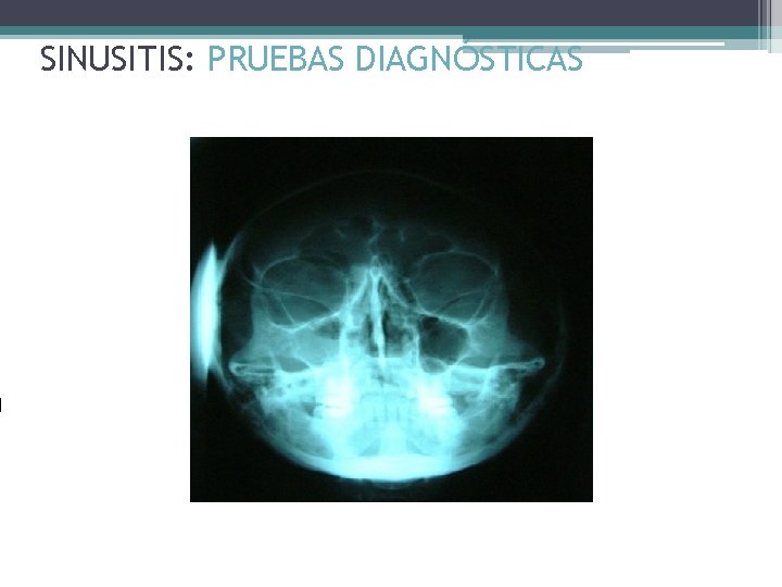 SINUSITIS: PRUEBAS DIAGNÓSTICAS 