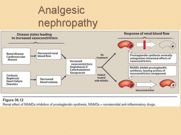 Analgesic nephropathy 