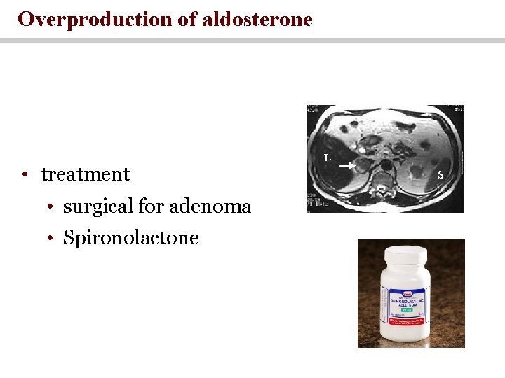 Overproduction of aldosterone • treatment • surgical for adenoma • Spironolactone 