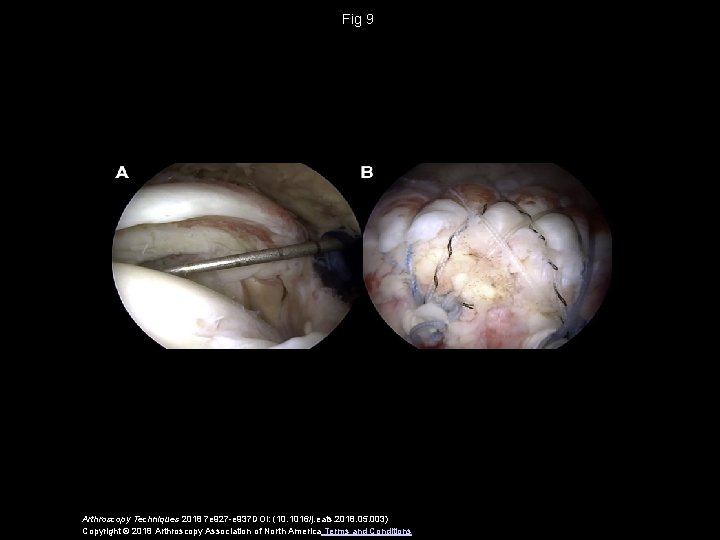 Fig 9 Arthroscopy Techniques 2018 7 e 927 -e 937 DOI: (10. 1016/j. eats.