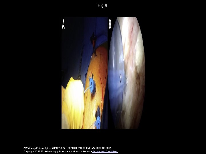 Fig 6 Arthroscopy Techniques 2018 7 e 927 -e 937 DOI: (10. 1016/j. eats.