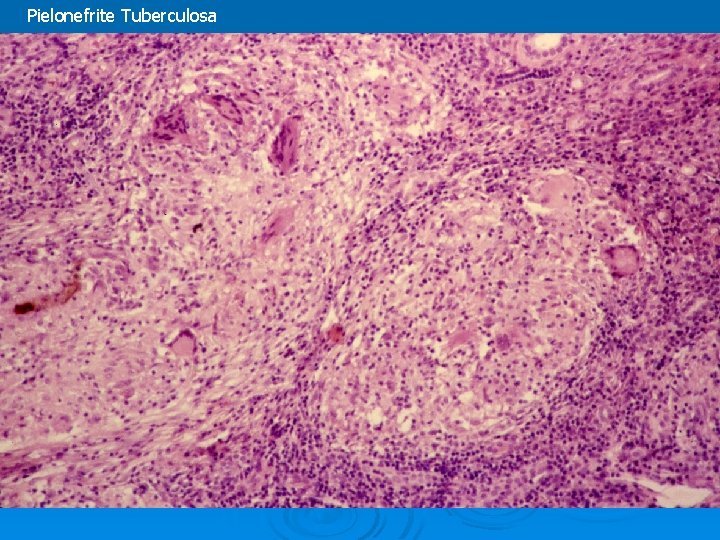 Pielonefrite Tuberculosa Pielonefrite Tuberculosa