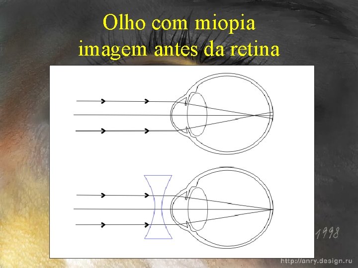 Olho com miopia imagem antes da retina 