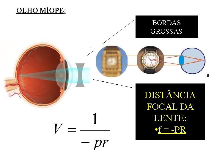 OLHO MÍOPE: BORDAS GROSSAS DIST NCIA FOCAL DA LENTE: • f = -PR 