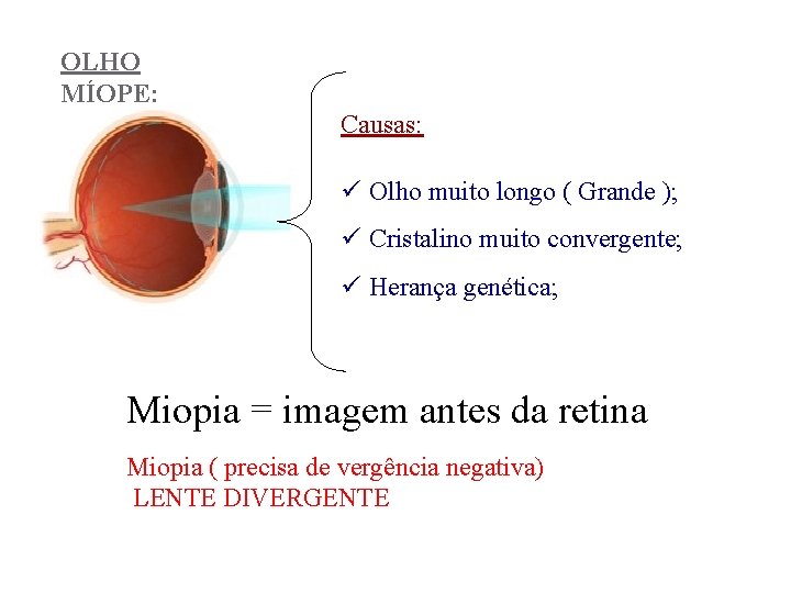 OLHO MÍOPE: Causas: ü Olho muito longo ( Grande ); ü Cristalino muito convergente;