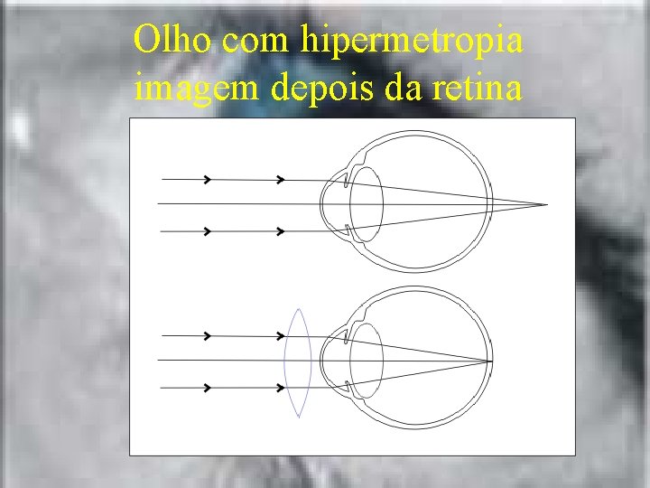 Olho com hipermetropia imagem depois da retina 