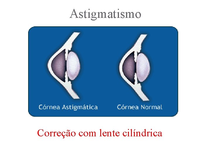 Astigmatismo Correção com lente cilíndrica 