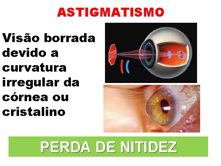 ASTIGMATISMO Visão borrada devido a curvatura irregular da córnea ou cristalino PERDA DE NITIDEZ