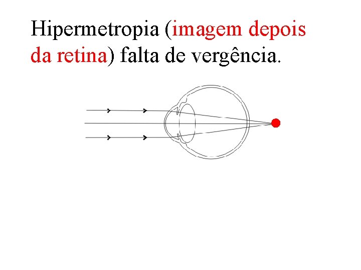 Hipermetropia (imagem depois da retina) falta de vergência. 