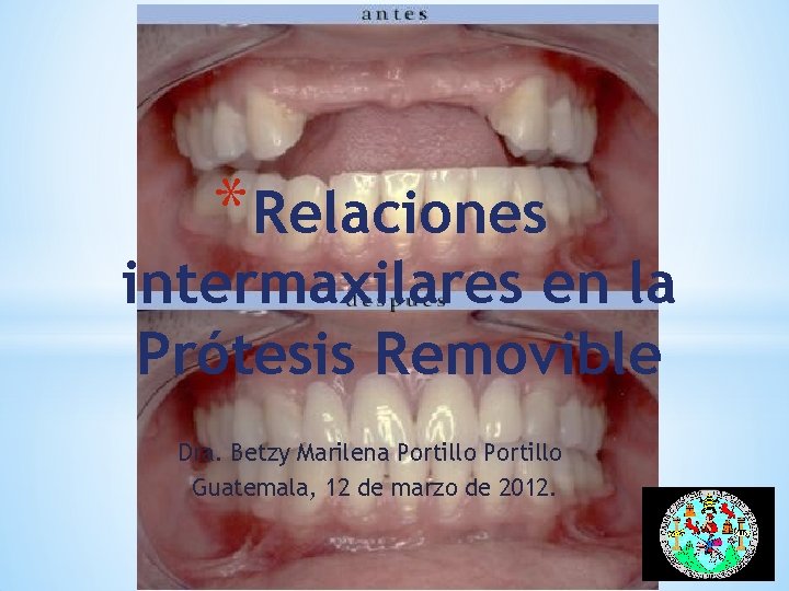 * Relaciones intermaxilares en la Prótesis Removible Dra. Betzy Marilena Portillo Guatemala, 12 de