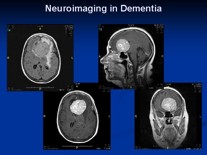 Neuroimaging in Dementia 