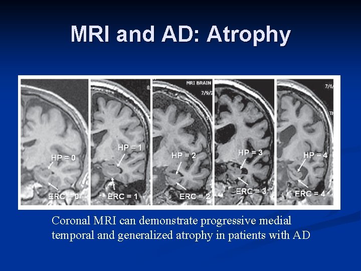 MRI and AD: Atrophy Coronal MRI can demonstrate progressive medial temporal and generalized atrophy