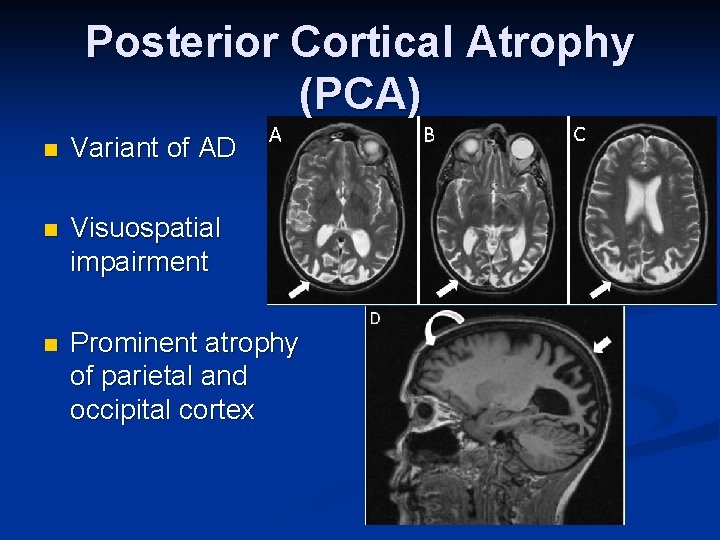 Posterior Cortical Atrophy (PCA) n Variant of AD n Visuospatial impairment n Prominent atrophy
