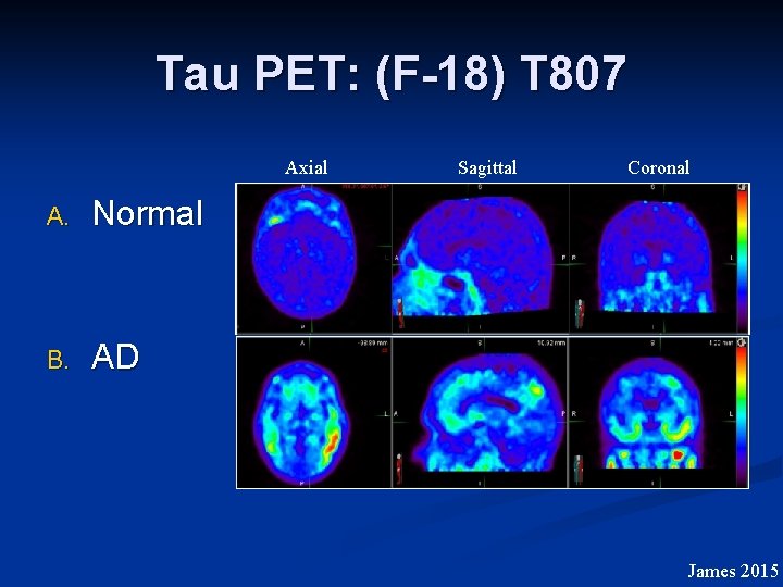 Tau PET: (F-18) T 807 Axial A. Normal B. AD Sagittal Coronal James 2015