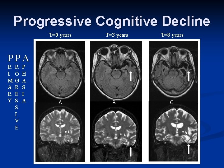 Progressive Cognitive Decline T=0 years PPA R I M A R Y R O