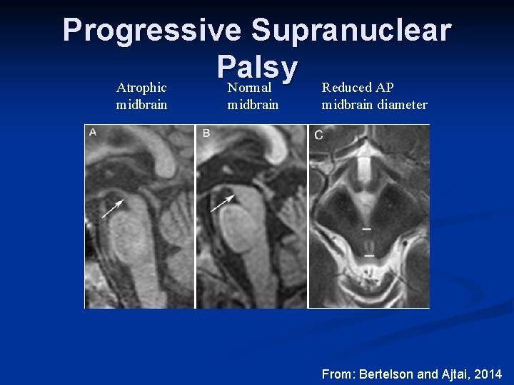 Progressive Supranuclear Palsy Reduced AP Atrophic Normal midbrain diameter From: Bertelson and Ajtai, 2014