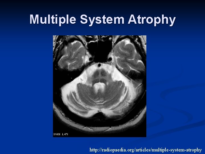 Multiple System Atrophy http: //radiopaedia. org/articles/multiple-system-atrophy 