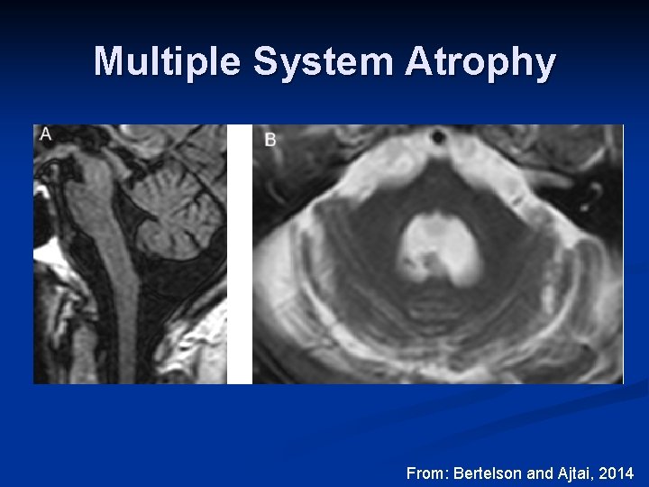 Multiple System Atrophy From: Bertelson and Ajtai, 2014 