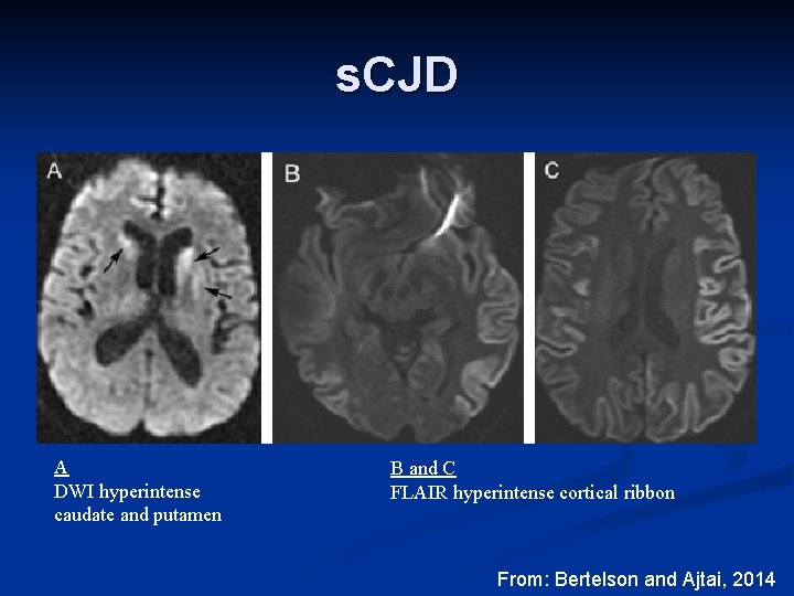 s. CJD A DWI hyperintense caudate and putamen B and C FLAIR hyperintense cortical