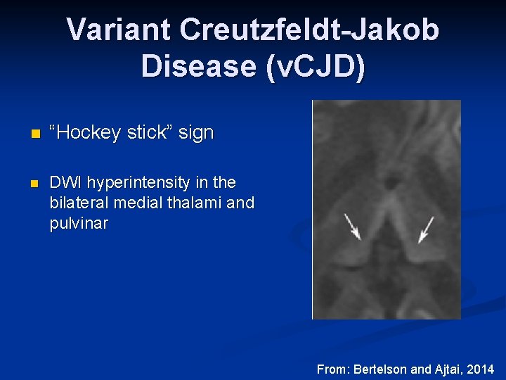 Variant Creutzfeldt-Jakob Disease (v. CJD) n “Hockey stick” sign n DWI hyperintensity in the