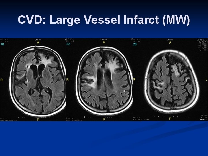 CVD: Large Vessel Infarct (MW) 