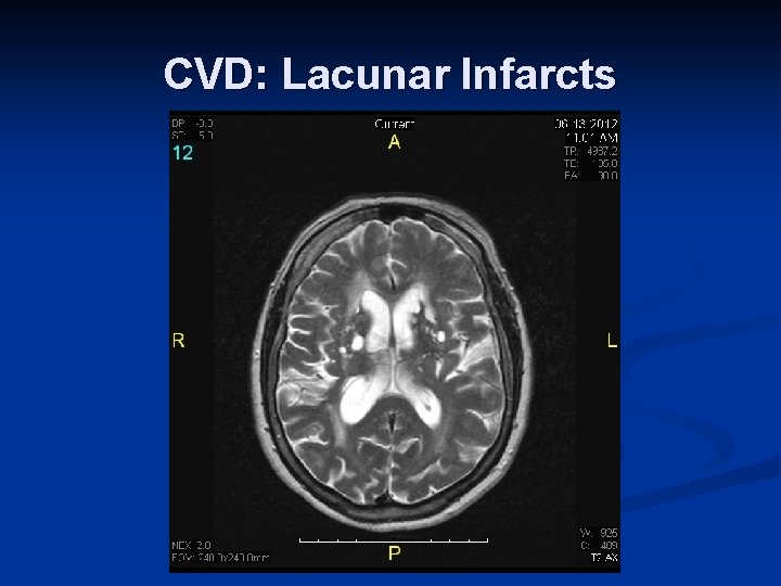 CVD: Lacunar Infarcts 