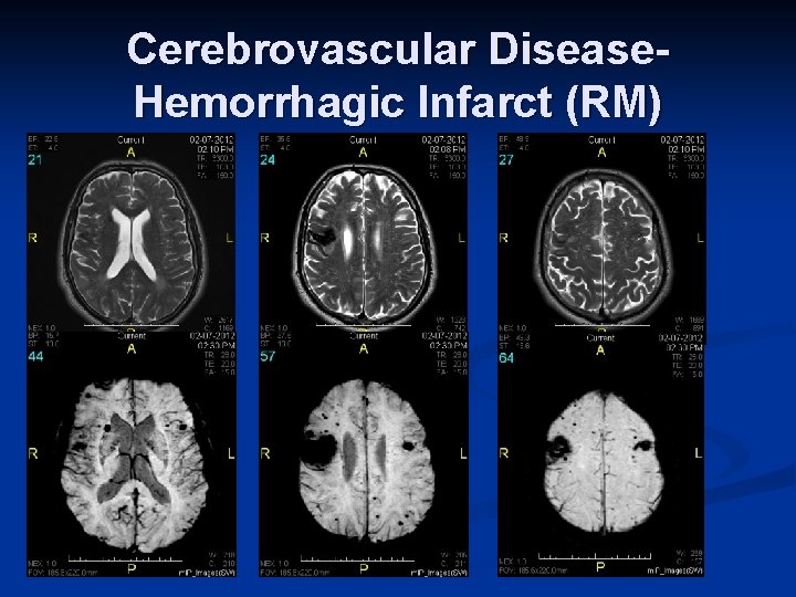 Cerebrovascular Disease. Hemorrhagic Infarct (RM) 