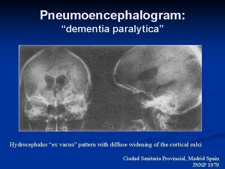 Pneumoencephalogram: “dementia paralytica” Hydrocephalus “ex vacuo” pattern with diffuse widening of the cortical sulci