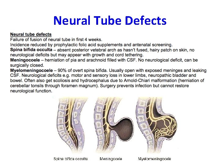 Neural Tube Defects 