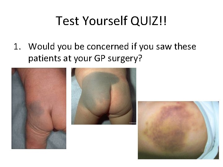 Test Yourself QUIZ!! 1. Would you be concerned if you saw these patients at