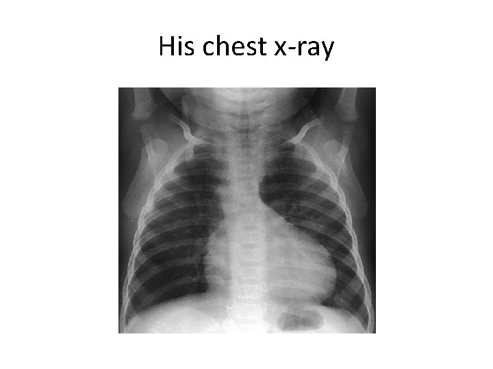 His chest x-ray 