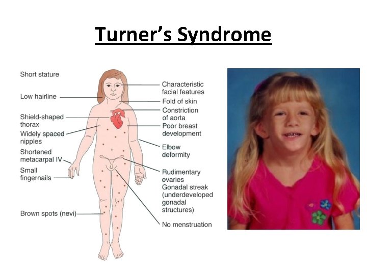 Turner’s Syndrome 