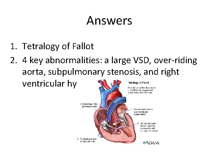 Answers 1. Tetralogy of Fallot 2. 4 key abnormalities: a large VSD, over-riding aorta,