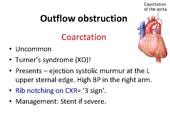 Outflow obstruction Coarctation • Uncommon • Turner’s syndrome (XO)! • Presents – ejection systolic