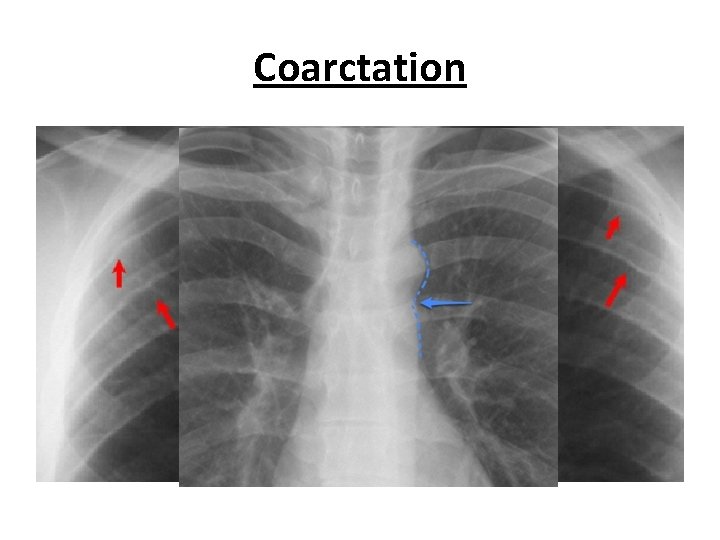 Coarctation 