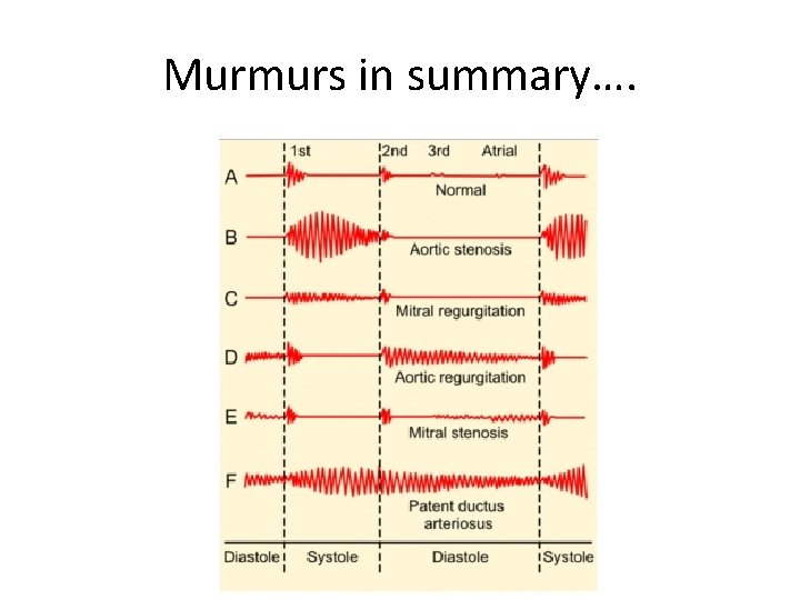 Murmurs in summary…. 