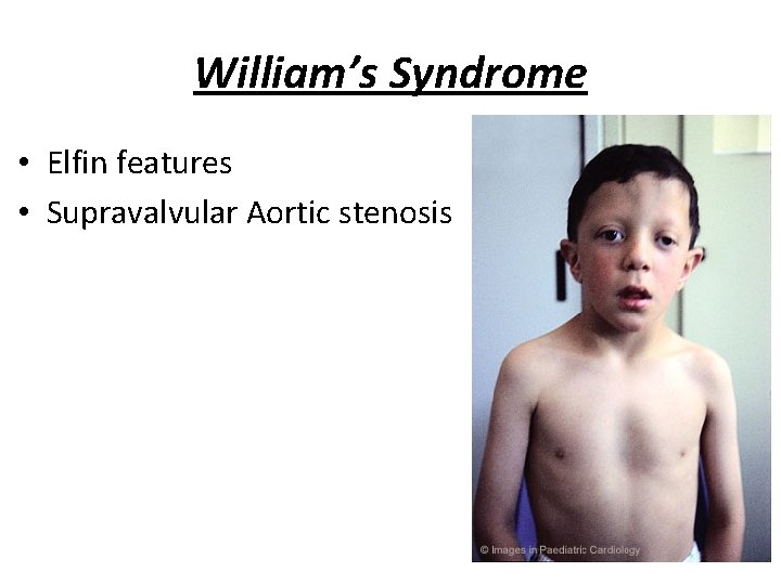 William’s Syndrome • Elfin features • Supravalvular Aortic stenosis 